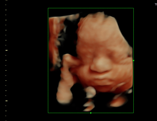 3D ultrasound image at 29 weeks